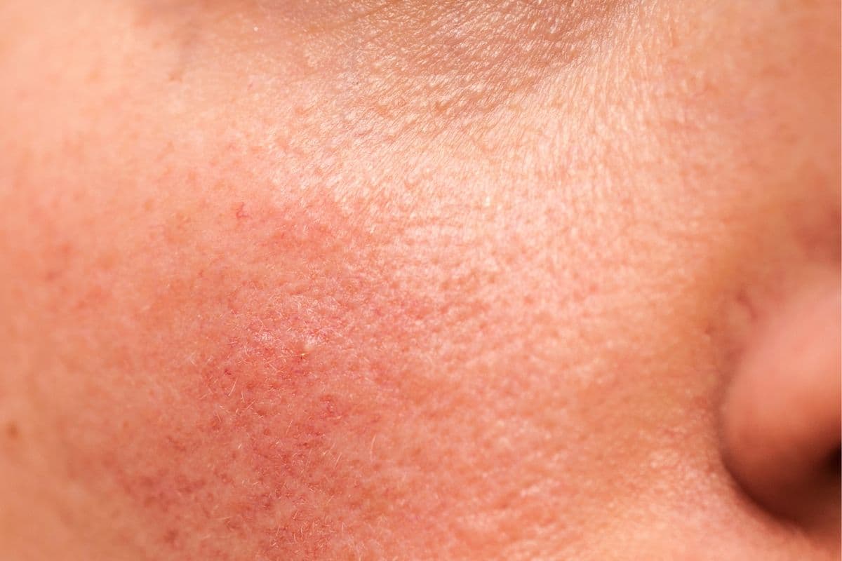 close up wajah pria yang mengelupas kemerahan