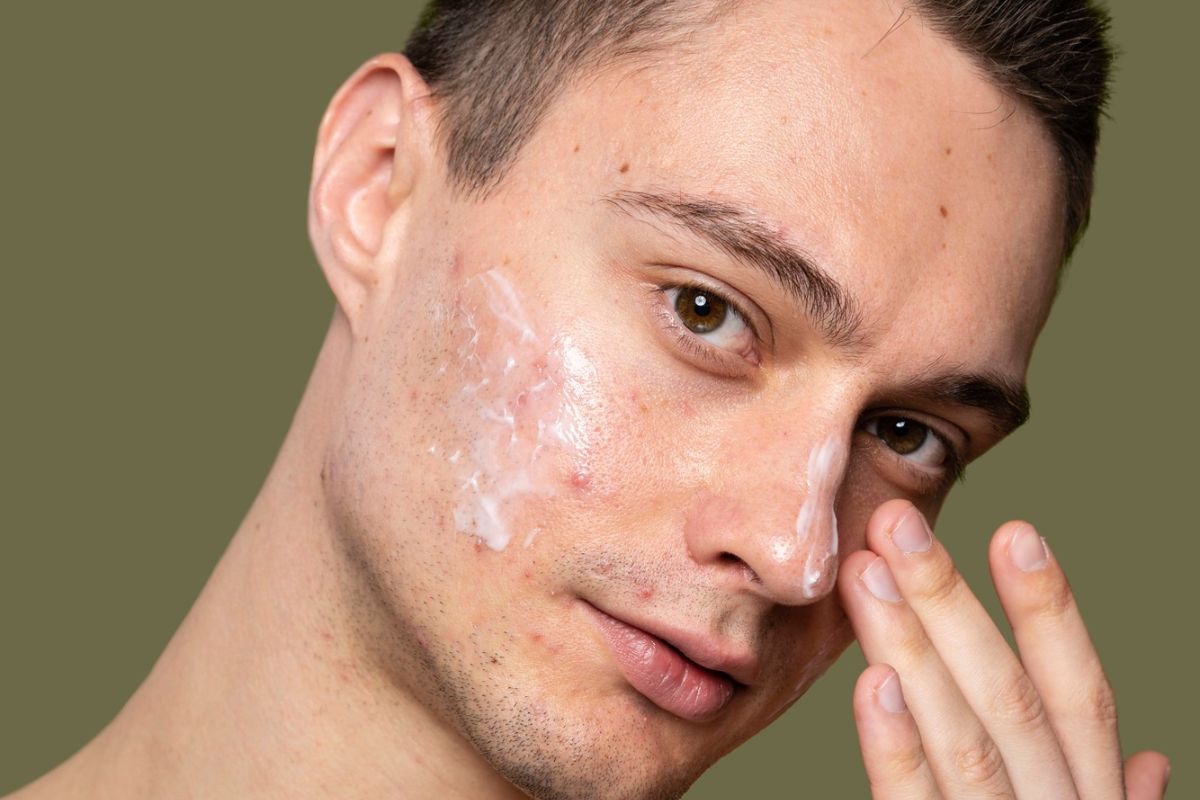 pria dengan kulit berminyak dan berjerawat memakai krim