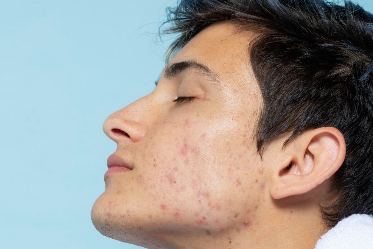 pria dengan wajah berjerawat