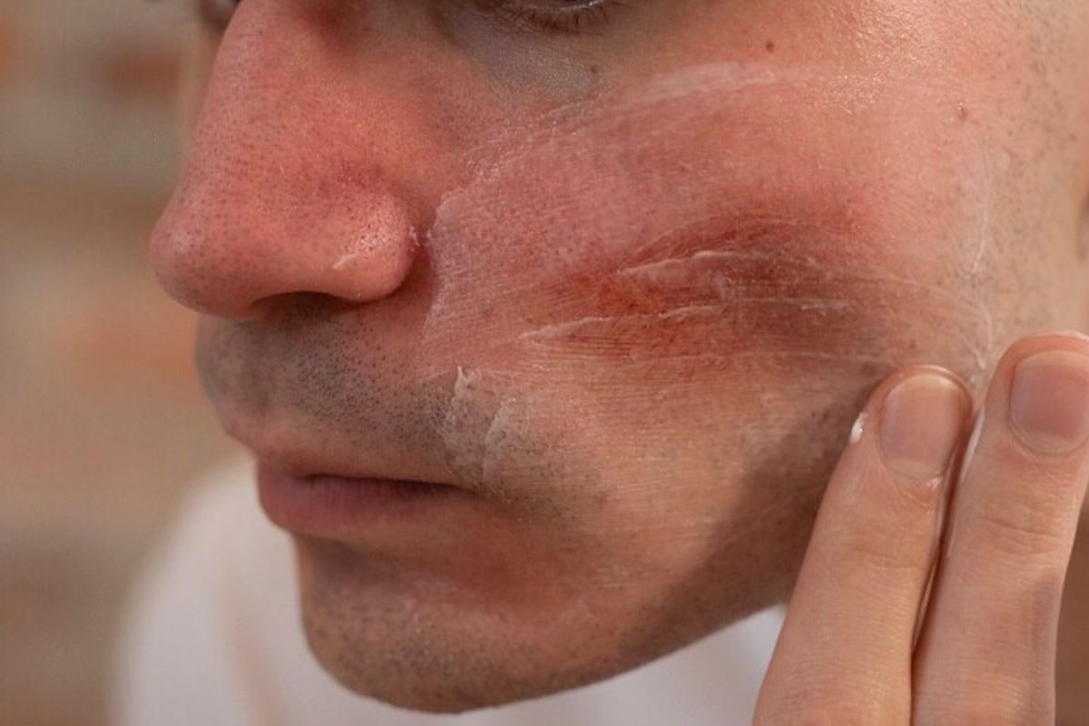 Pria yang kulitnya kering kemerahan