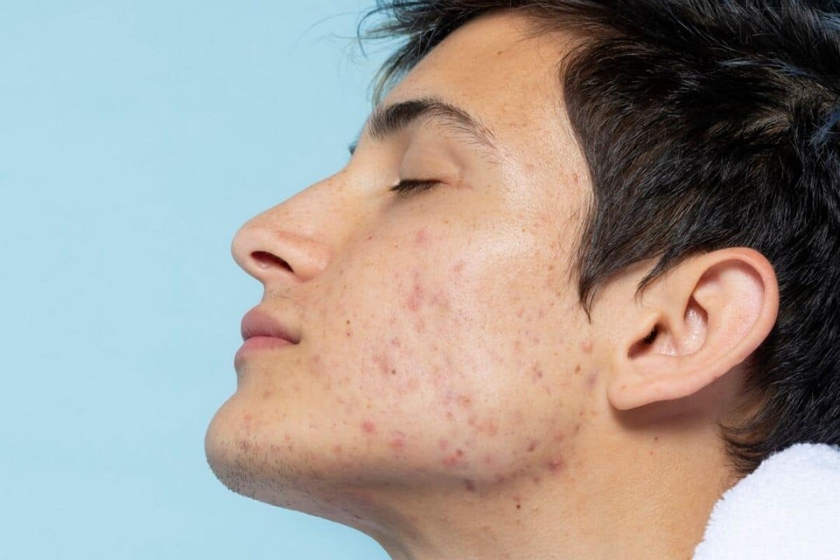 Dark spot dan bekas jerawat di wajah