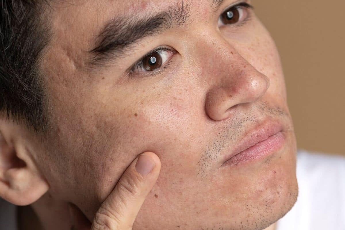 Pria dengan bekas bopeng