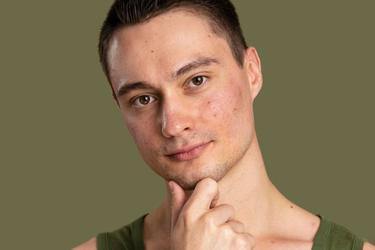 Bekas jerawat merah di wajah pria