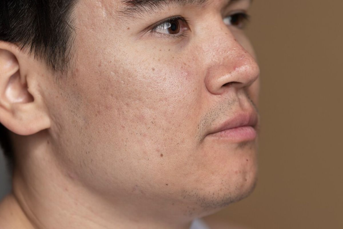 Pria dengan pori-pori besar