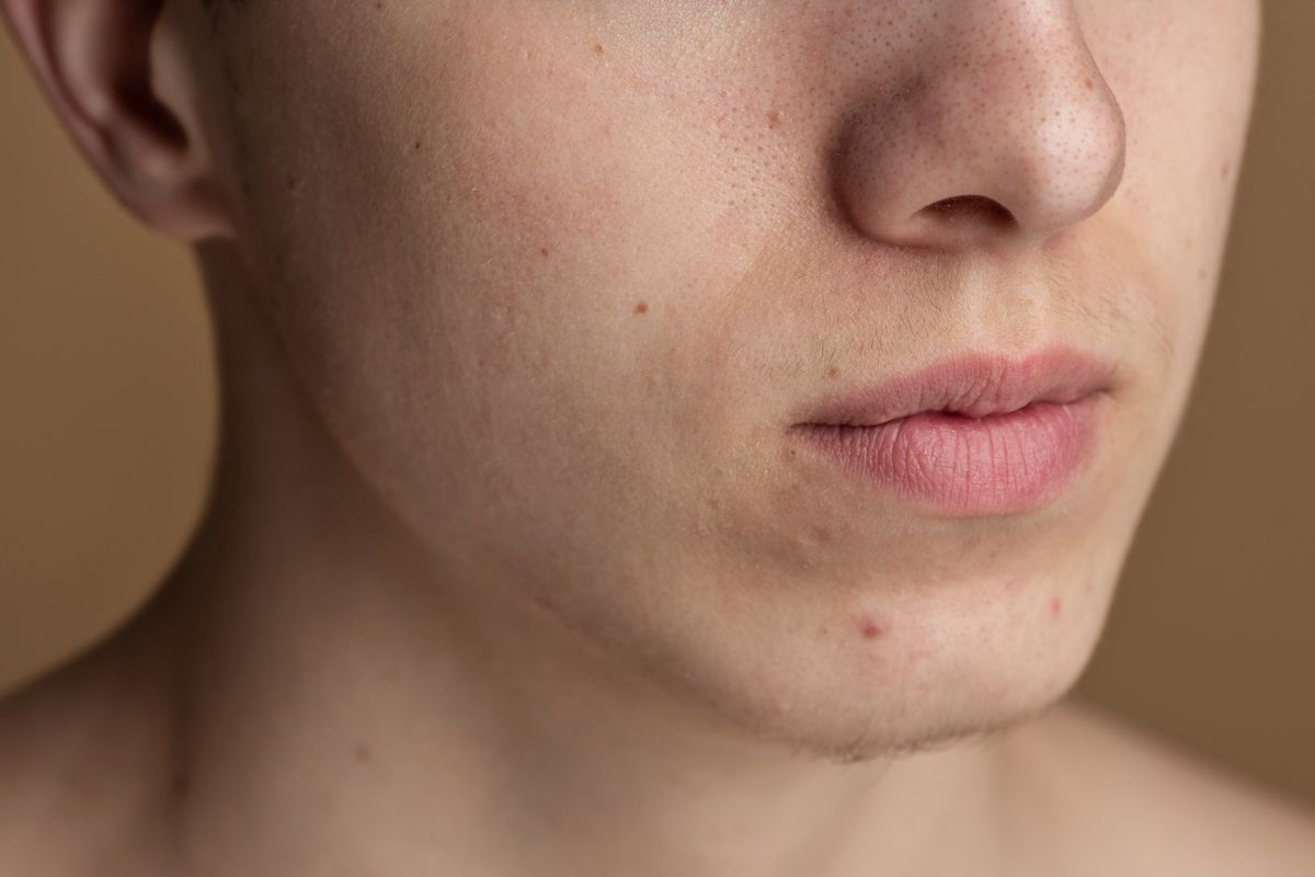 close up muka pria berjerawat