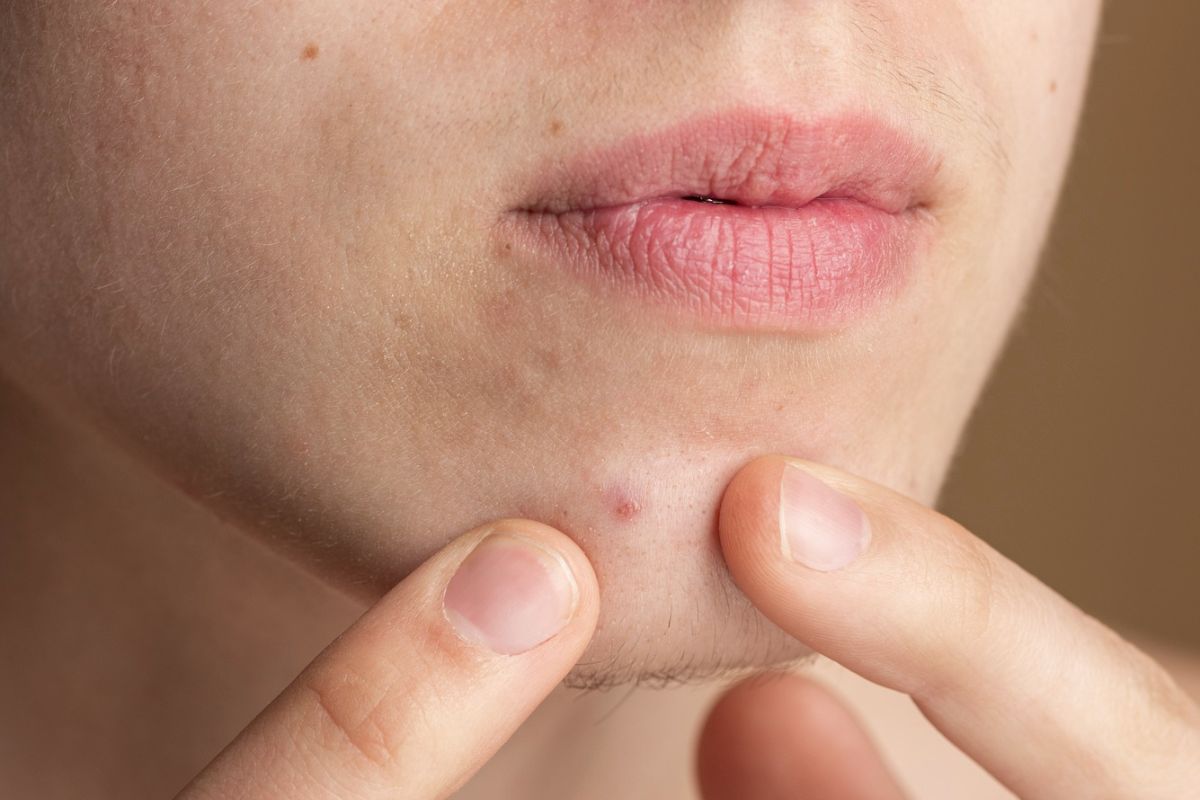 pria memencet jerawat dengan jari tangan