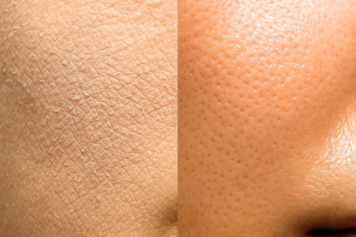 Perbandingan kulit jika kekurangan dan kelebihan sebum